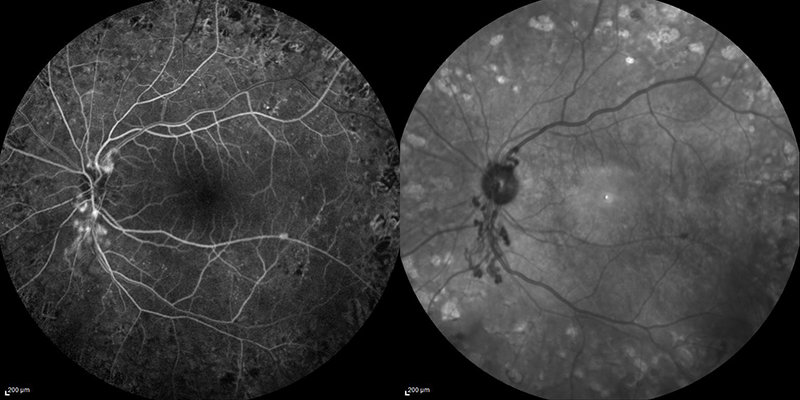 Proliferative Diabetic retinopathy FA L