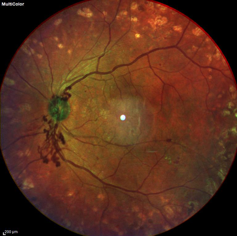 Proliferative Diabetic retinopathy fundus photo L