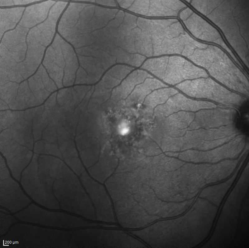 central serous retinopathy black and white fundus