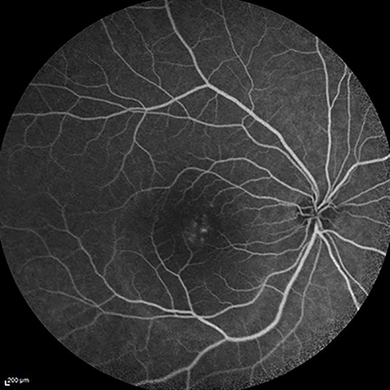 central serous retinopathy FA