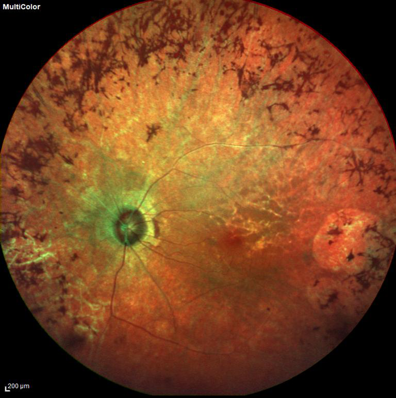 fundus photo of retinitis pigmentosa