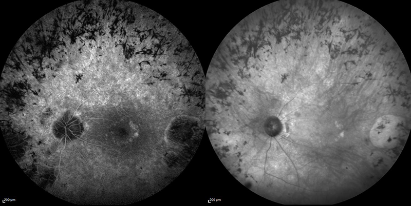 fluorescein angiogram and infrared fundus photo of retinitis pigmentosa 