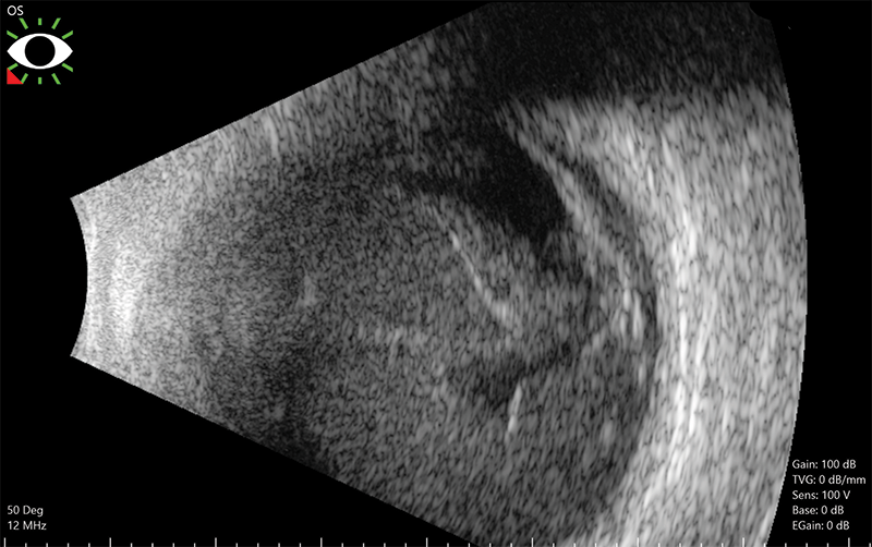 ultrasound of Endophthalmitis