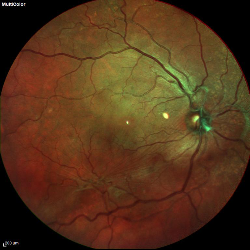 fundus photo of a macular pucker 