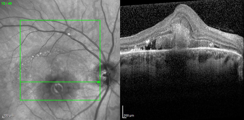 OCT of ocular histoplasmosis syndrome