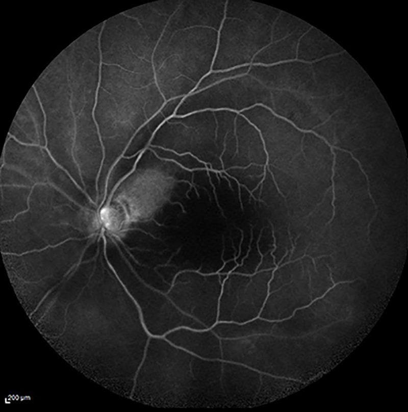 fluorescein angiogram of retinal artery occlusion