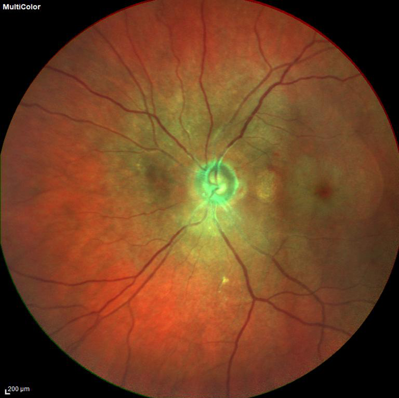 fundus photo of retinal artery occlusion 