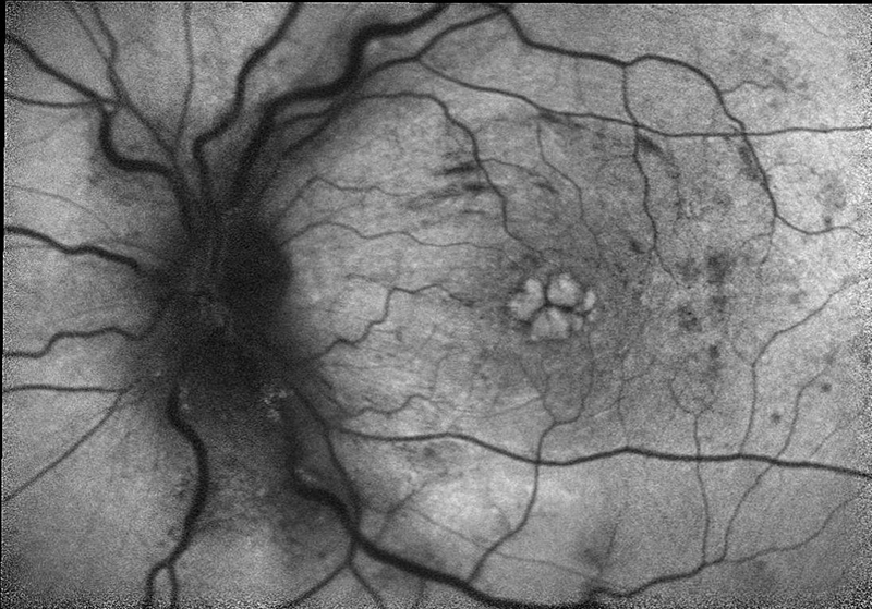 autofluorescence fundus photo of central retinal vein occlusion with macular edema 