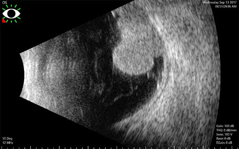 Choroidal Melanoma Ultrasound