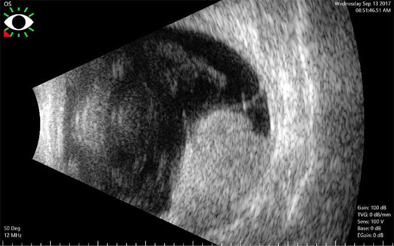 Choroidal Melanoma Ultrasound