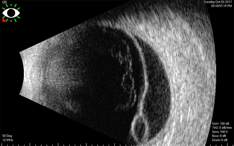 ultrasound of Retinal Detchament with retinoschisis