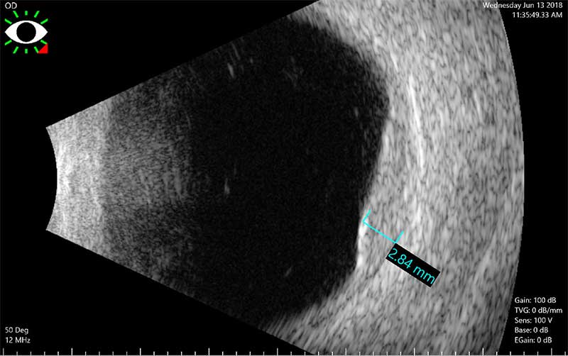 Choroidal metastasis ultrasound