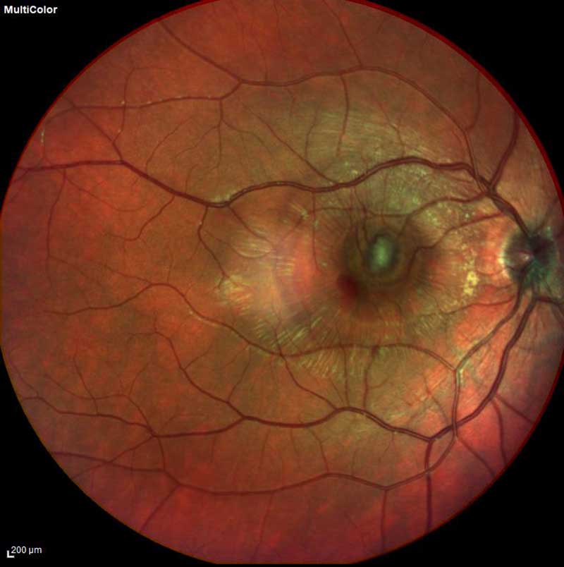 fundus photo with choroidal neovascular membrane