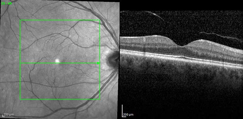 normal OCT of the macula