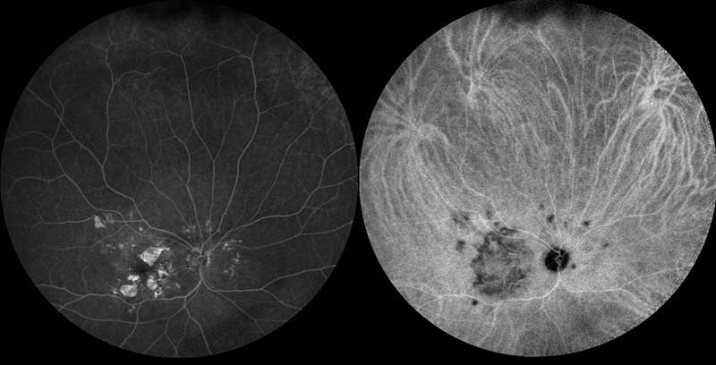 ultra-wide field fluorescein and indocyanine green angiogram of dry macular degeneration