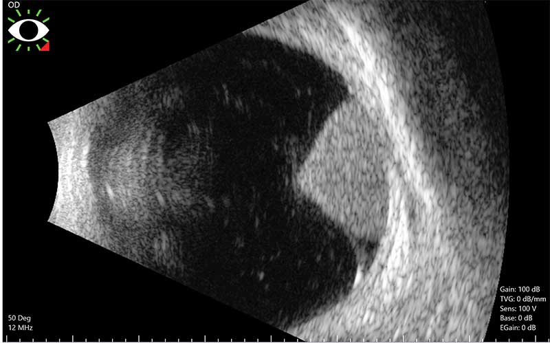 ultrasound of a choroidal melanoma