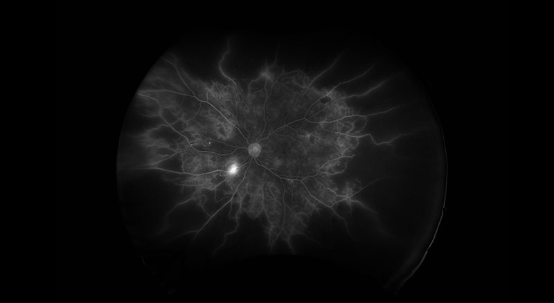 PDR Fluorescein Angiography